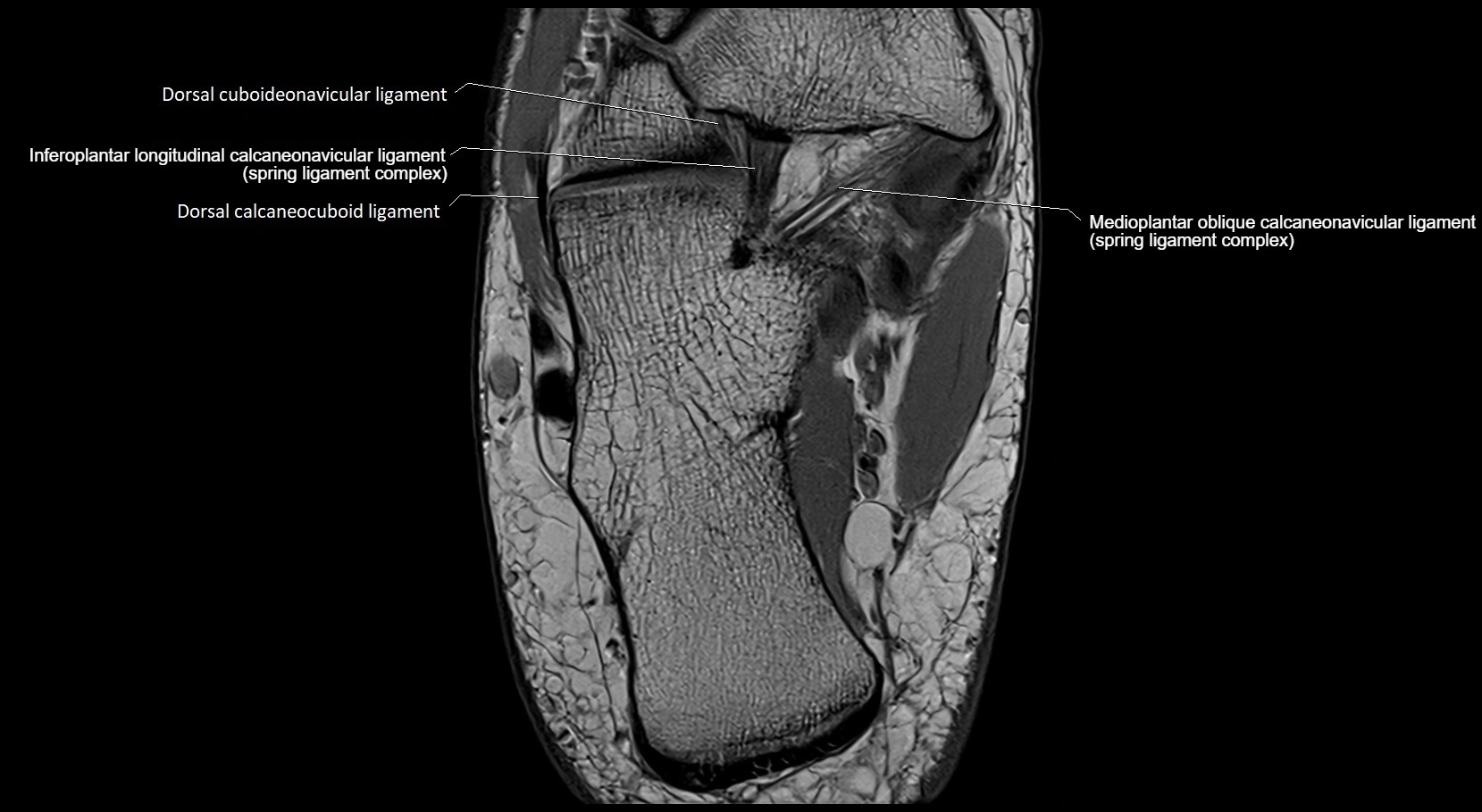 MRI ankle ligaments anatomy axial 3T image 20.webp